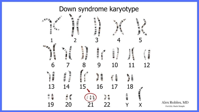 picture of the 23 pairs of chromosomes on a karyotype, showing an extra chromosome 21, which is down syndrome