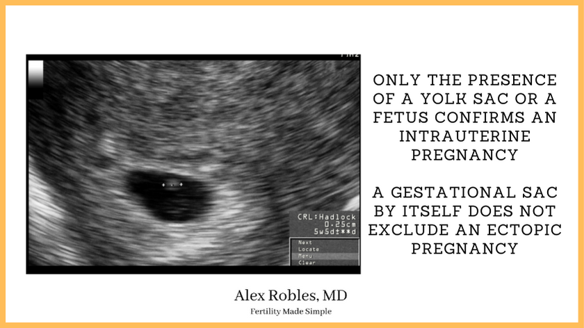 a picture of a ultrasound showing a small pregnancy inside the uterus saying: only the presence of a yolk sac or a fetus confirms an intrauterine pregnancy. a gestational sac by itself does not exclude an ectopic pregnancy.