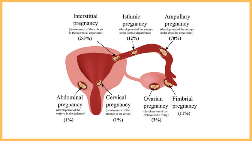 types-of-ectopic-pregnancies located in different parts of the fallopian tube, also on the ovary and abdomen