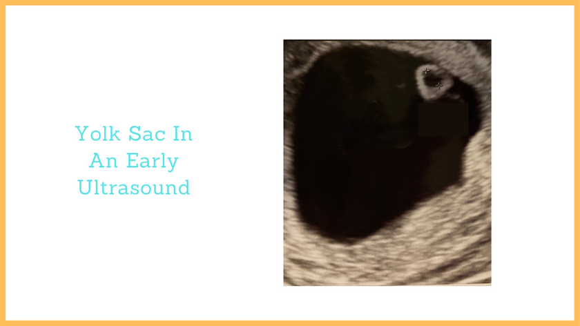 a picture of a yolk-sac - a small circular structure inside the gestational sac of a uterus