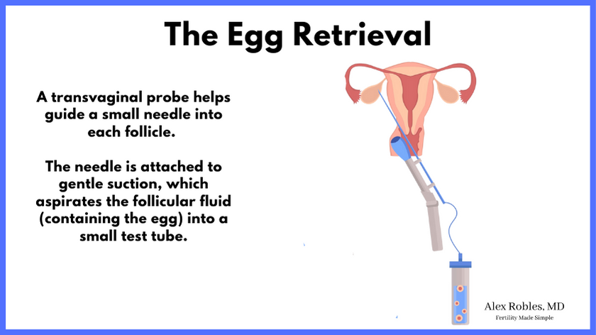 egg-retrieval: picture of a uterus and a transvaginal ultrasound probe: "a transvaginal probe helps guide a small needle into each follicle. the needle is attached to gentle suction, which aspirates the follicular fluid containing the egg into a small test tube