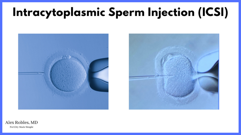 image of an egg being injected with a small needle to place the sperm inside the egg: intracytoplasmic sperm injection (ICSI)