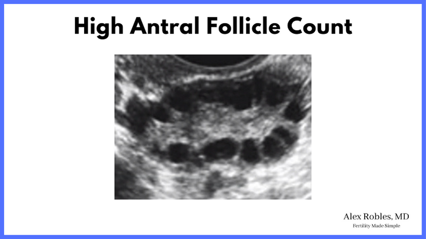 ultrasound image of an ovary showing many antral follicles