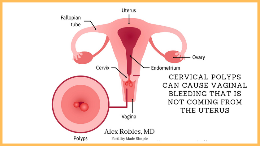 cartoon of uterus and cervix with polyps growing on the cervix