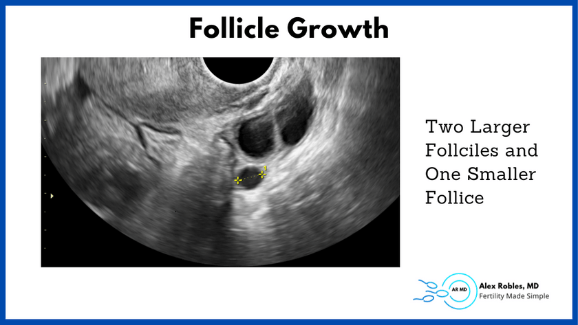 ultrasound image showing two larger follicles and one smaller follicle