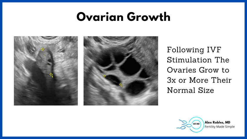 Following ivf stimulation the ovaries grow to 3x or more their normal size